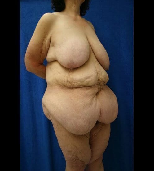 before360bodylift