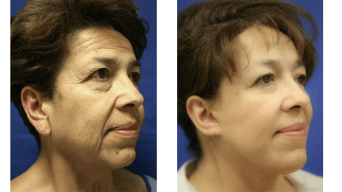 Facial Rejuvenation: Surgical Brow Lift and Mid-face Lift