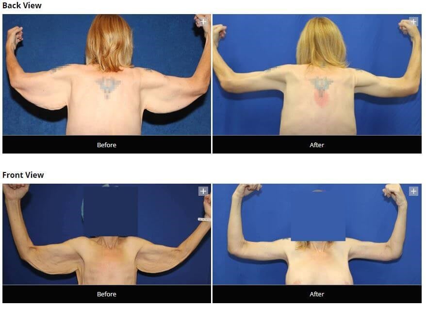 Armpit fat before and after Brachioplasty, liposuction or plastic