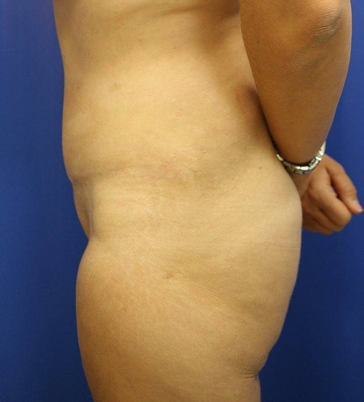 Abdominoplastia después de Cesárea: ¿Es Factible?