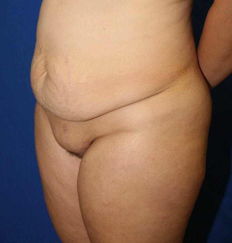 Abdominoplastia después de Cesárea: ¿Es Factible?