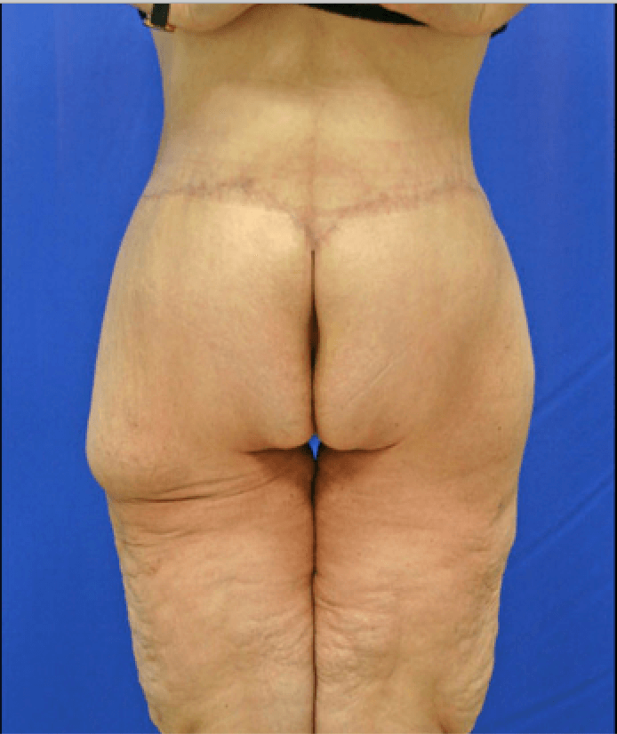 Circumferential Tummy Tuck/Lower Body Lift Photo Gallery – Dr John