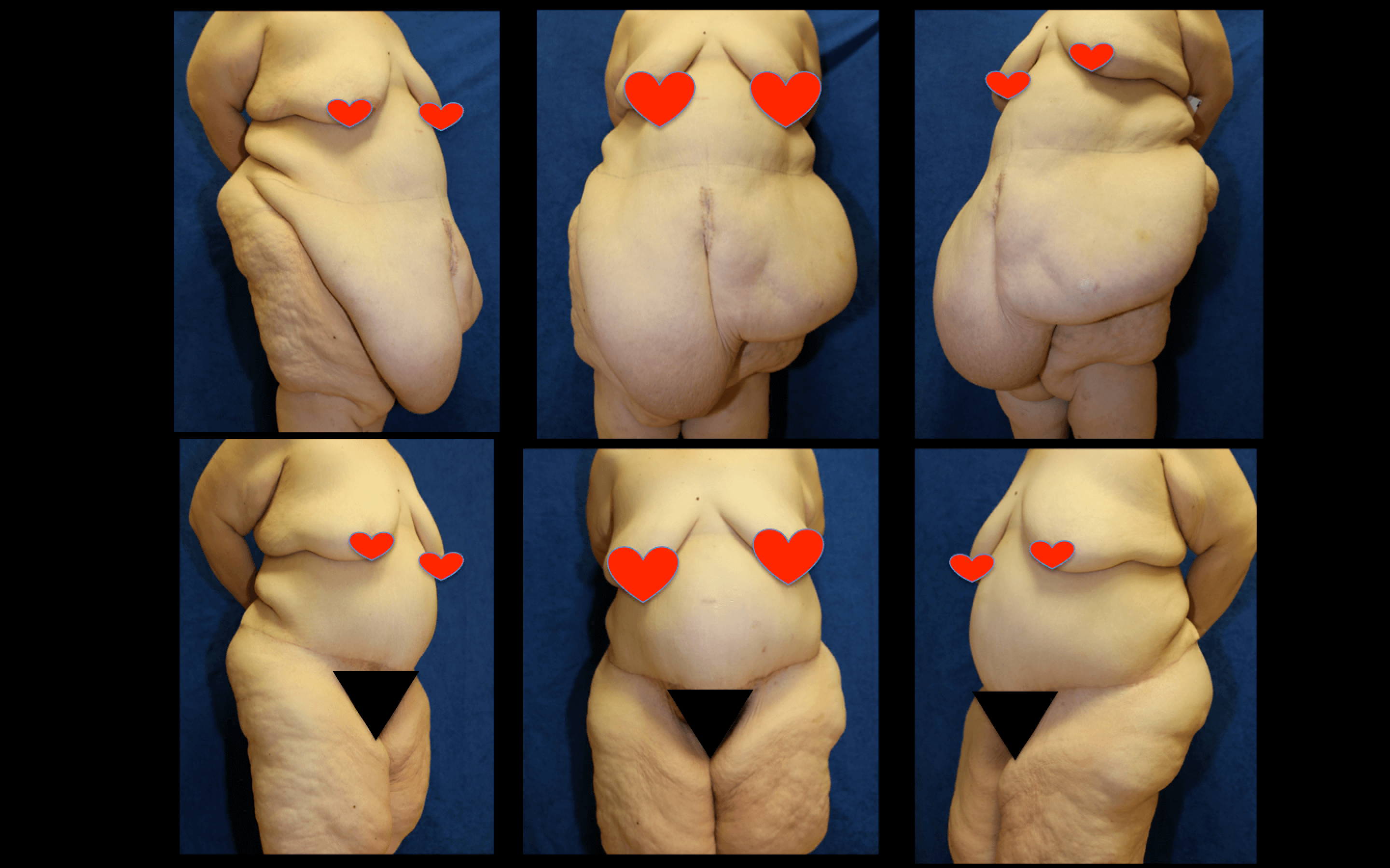 What Is The Difference Between A Panniculectomy And A Tummy Tuck