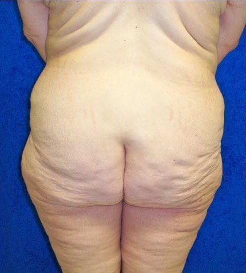 Circumferential Lipectomy (Body Lift) - The Coastal Clinic Plastic