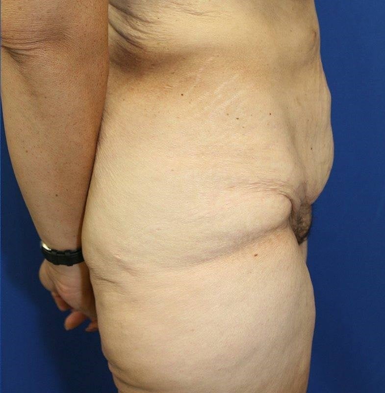 The Difference Between a Panniculectomy and a Tummy Tuck