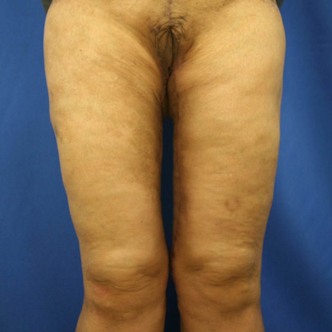 Thigh Lift Scars After 1 Year: Things to Expect - Salameh Plastic