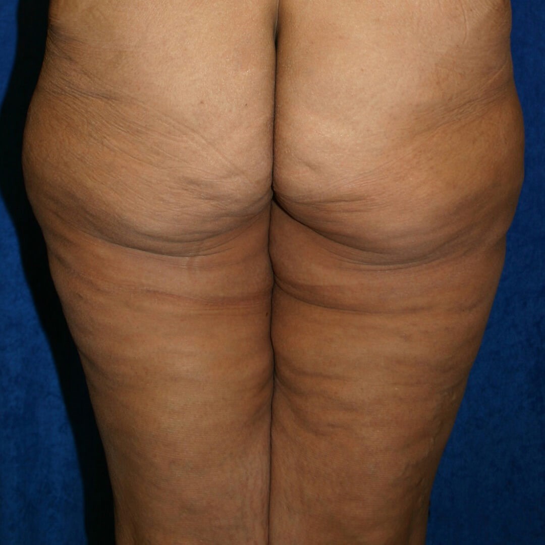 Thigh Lift Scars After 1 Year: Things to Expect - Salameh Plastic