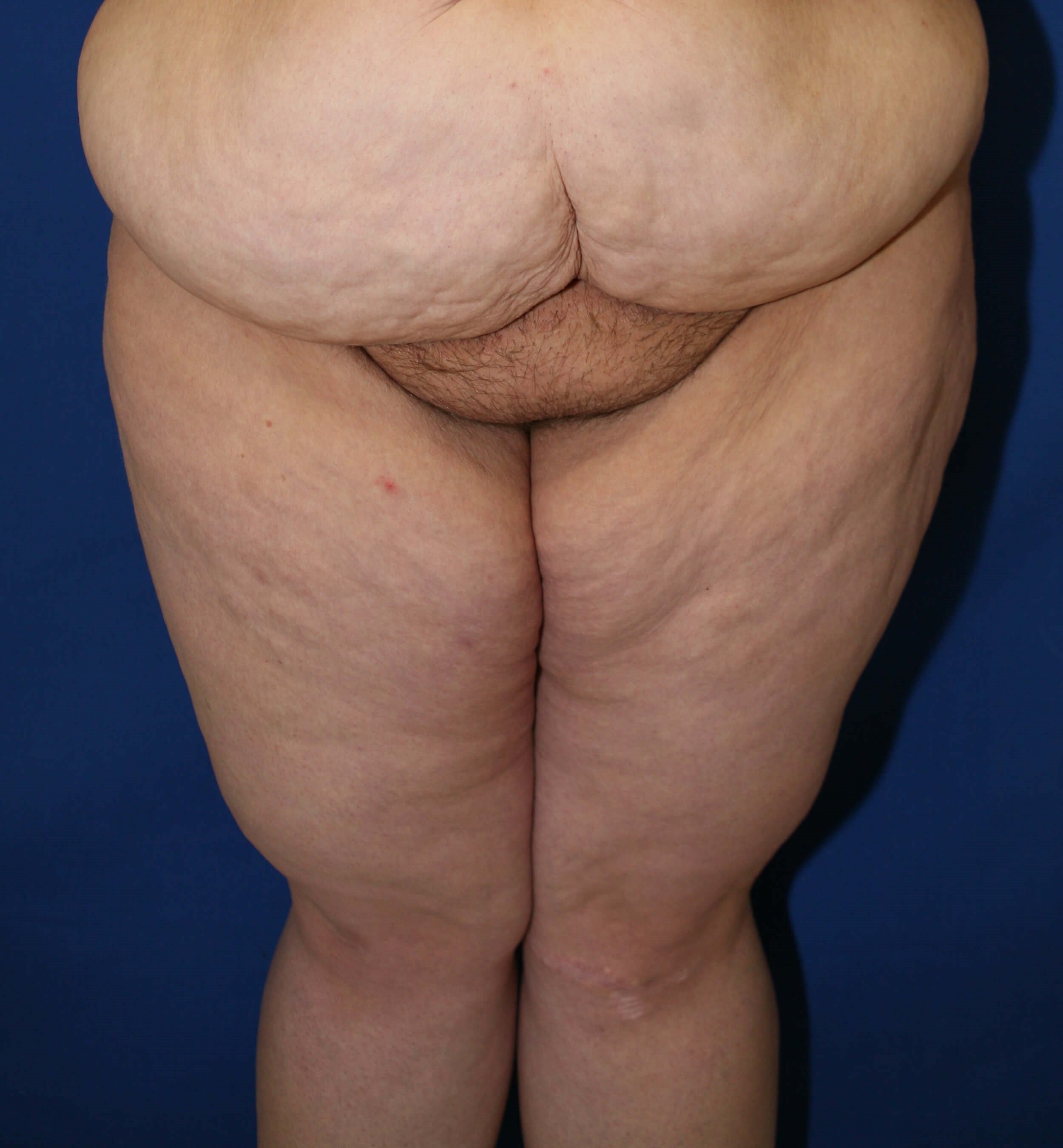 Mastering a Smooth Thigh Lift Surgery Recovery: Essential Steps