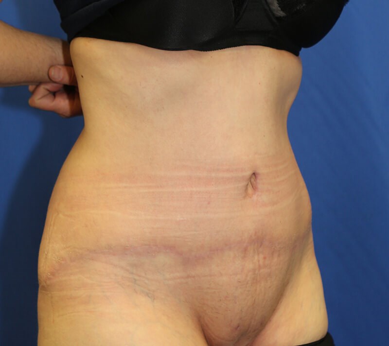 El tiempo de recuperación después de una cirugía de una abdominoplastia  varía según los casos, puede ser entre 15 días y 3 semanas