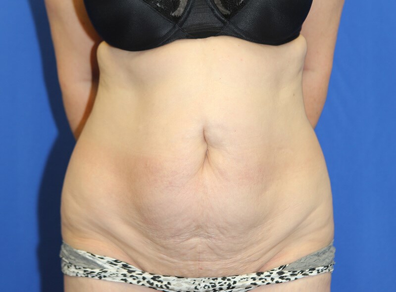 Cuánto tiempo dura la recuperación después de una abdominoplastia?