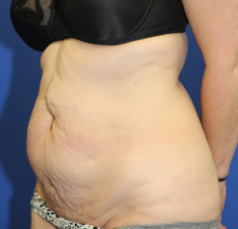 Cuánto tiempo debo caminar encorvada después de una abdominoplastia