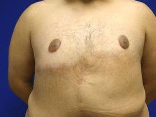 What You Need To Know About One-sided Gynecomastia