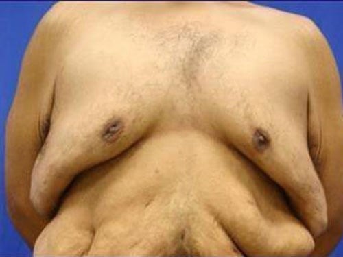 What You Need To Know About One-sided Gynecomastia