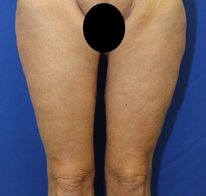 Thigh Lift Scars After 1 Year: Things to Expect - Salameh Plastic