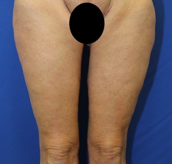 What will my Thigh Lift scar look like?