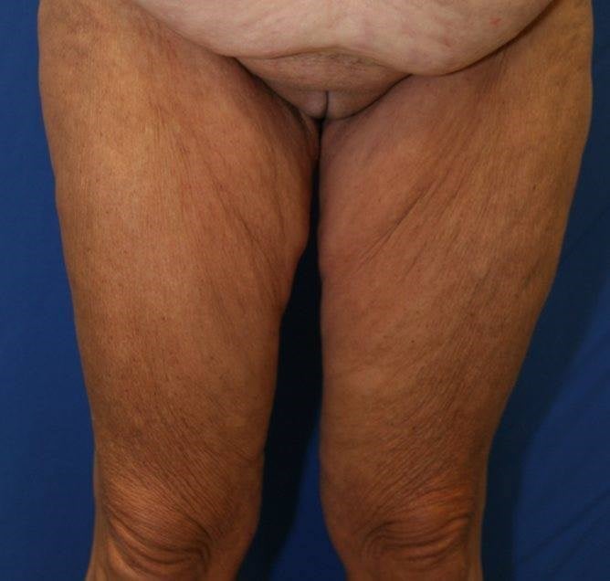 What will my Thigh Lift scar look like?