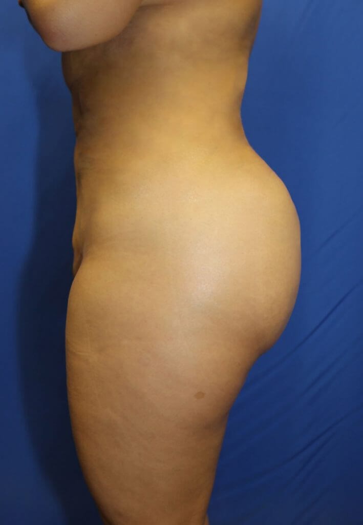 Butt Lift Before & After Photos in Las Vegas, NV