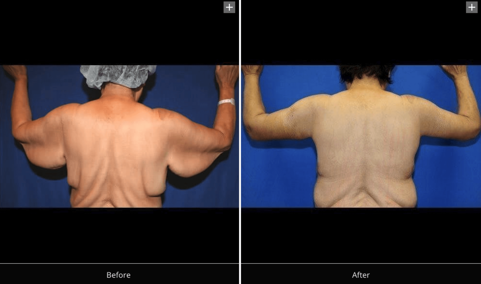 Brachioplasty: Cost, Recovery, Before and Afters of Arm Lift