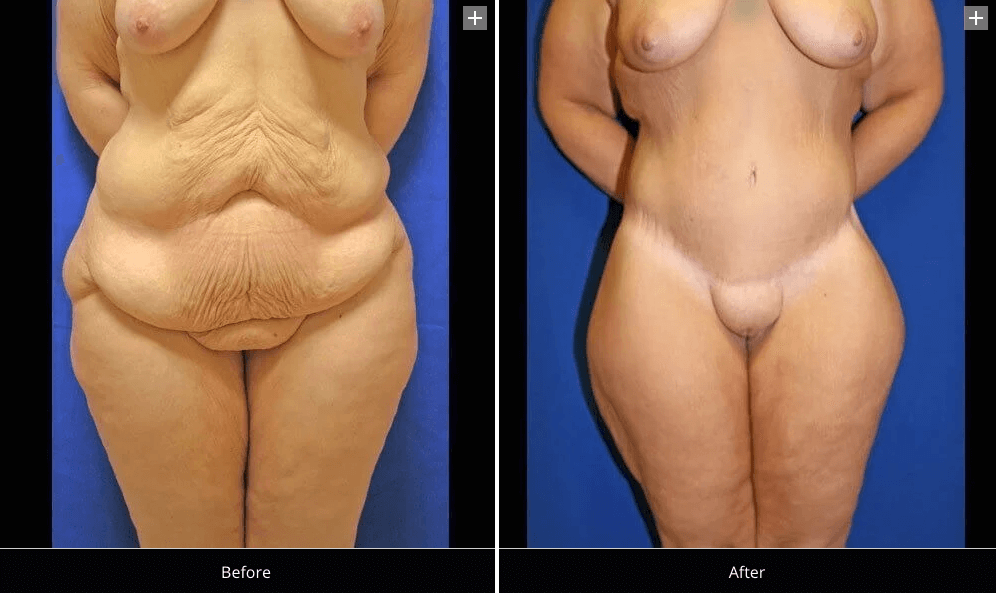 Before and After