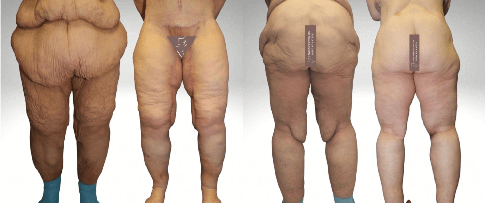 Before and After