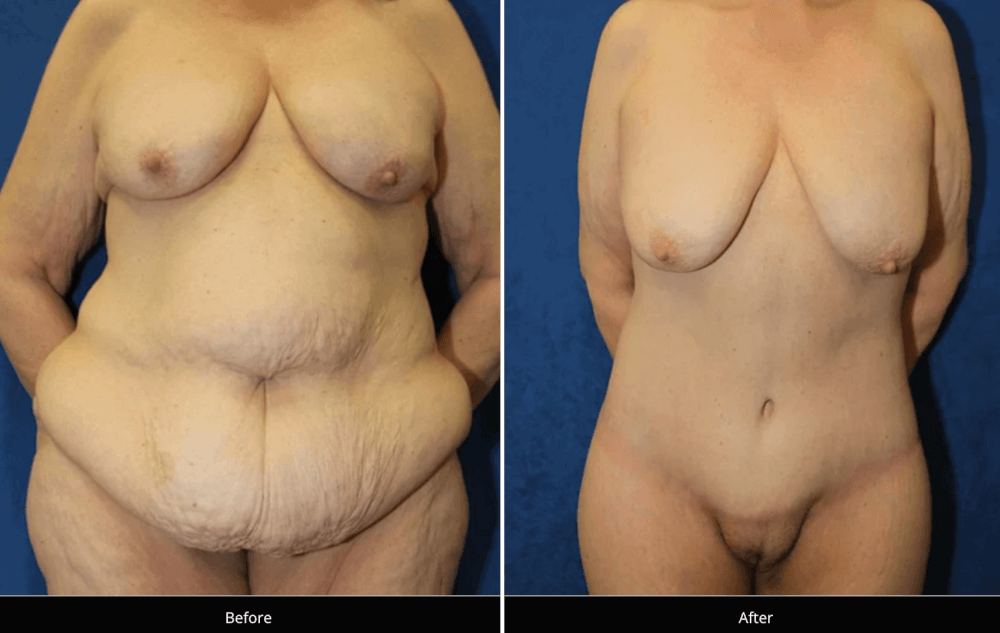 Before & After