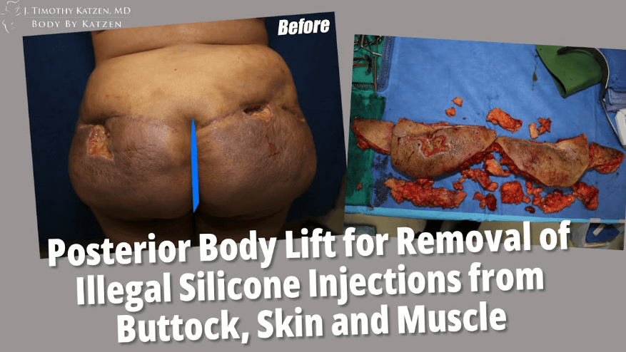 Posterior Body Lift