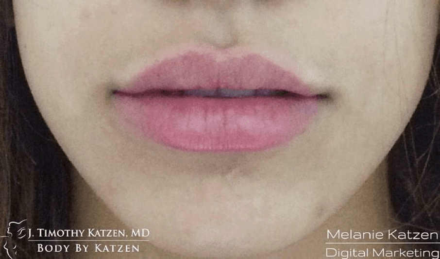 after results of lip filler