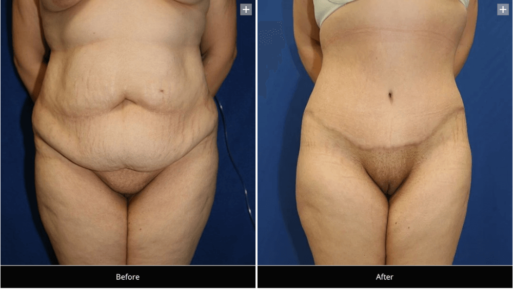 Prevenir una infección después de una abdominoplastia - Spanish Hourglass  Tummy Tuck