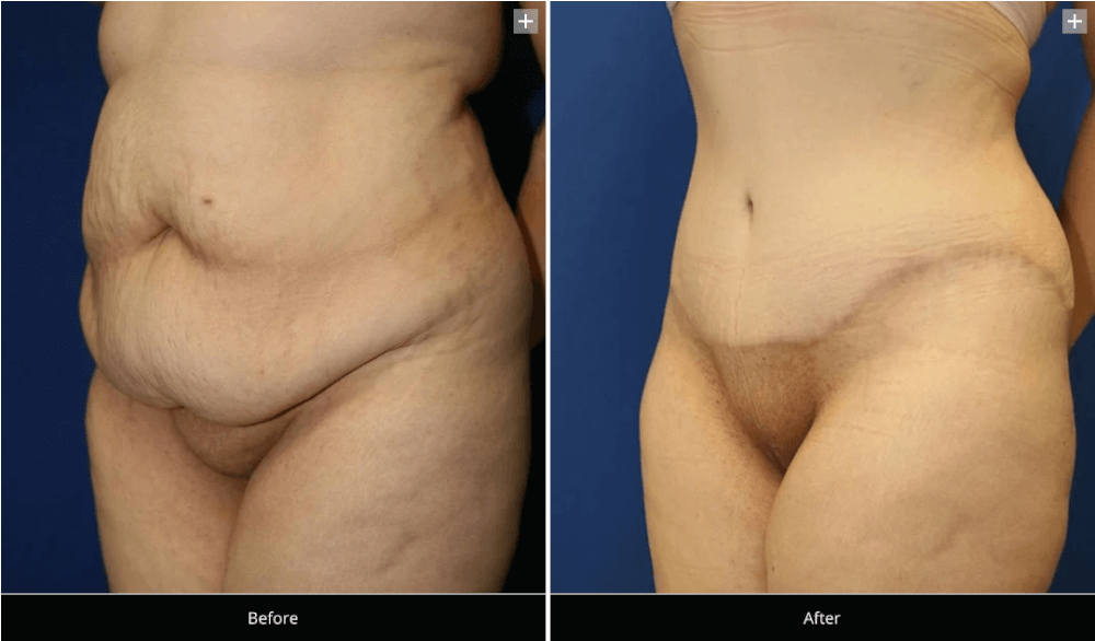 What can I wear during tummy tuck recovery? - Granite Bay Cosmetic Surgery