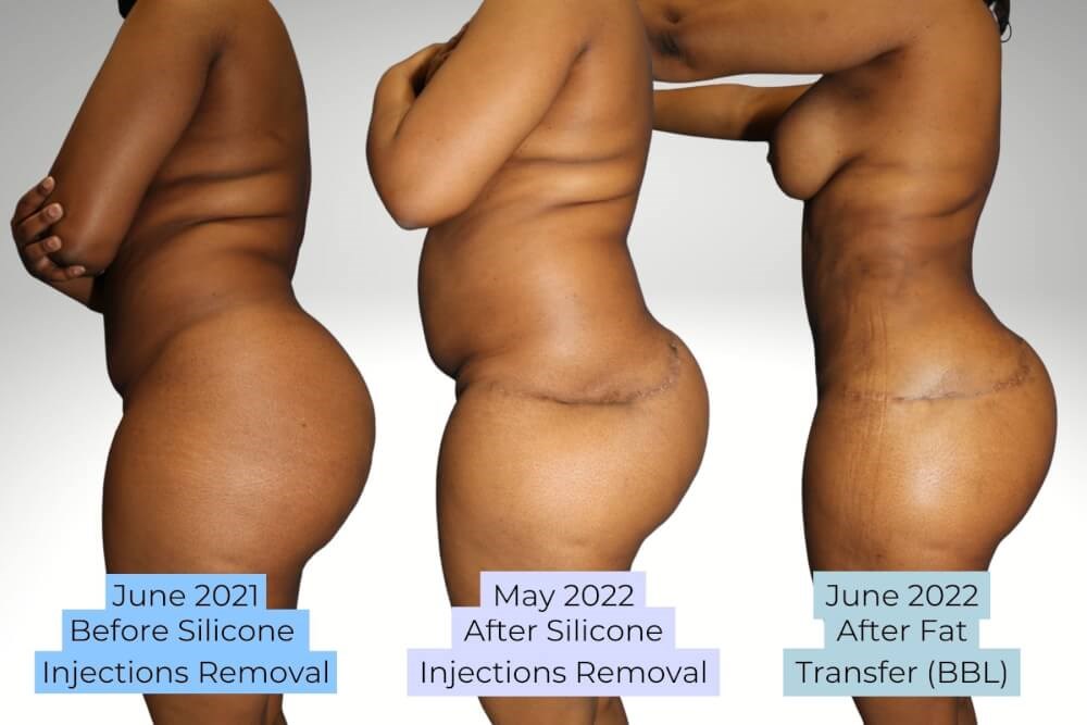 Before and After