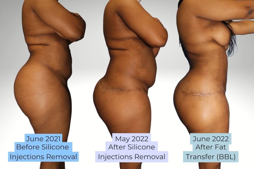 Before and After