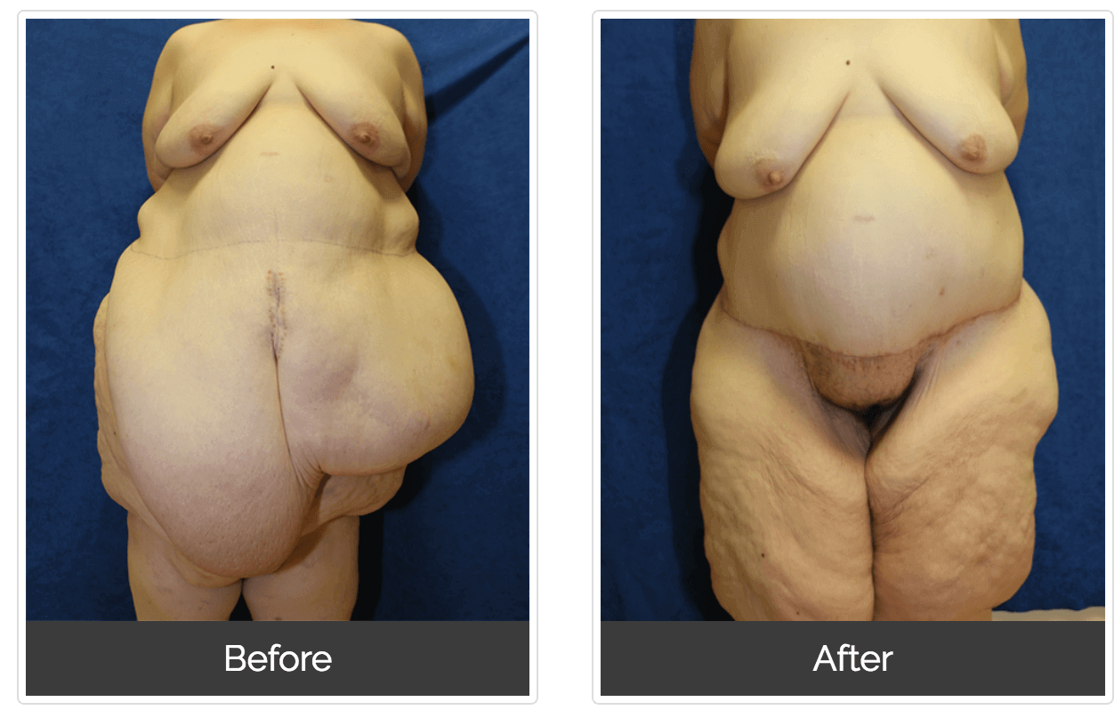 What To Expect During Recovery From Tummy Tuck Surgery – The Gill Center  for Plastic Surgery and Dermatology