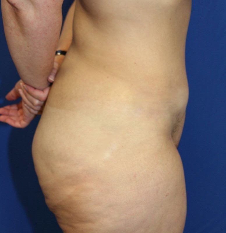 How Noticeable Will My Scars Be After A Tummy Tuck?