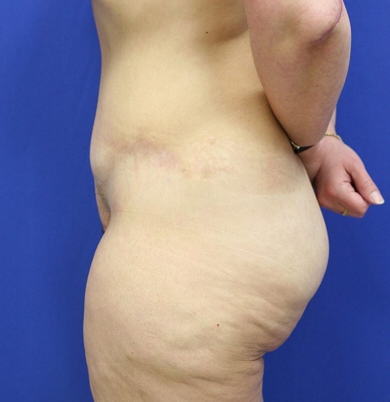 Why You Shouldn't Be Scared of a Tummy Tuck Scar - Body By Leverett