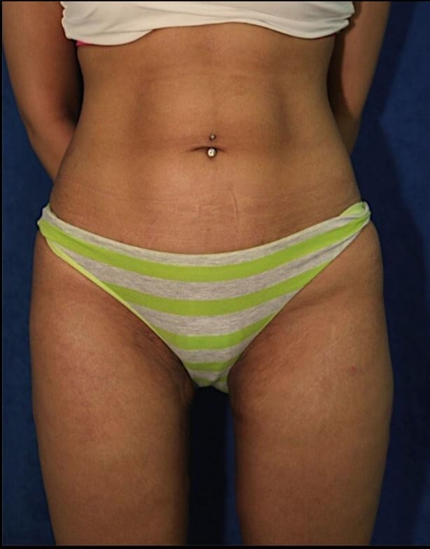 Vaser Liposuction with Abdominal Etching