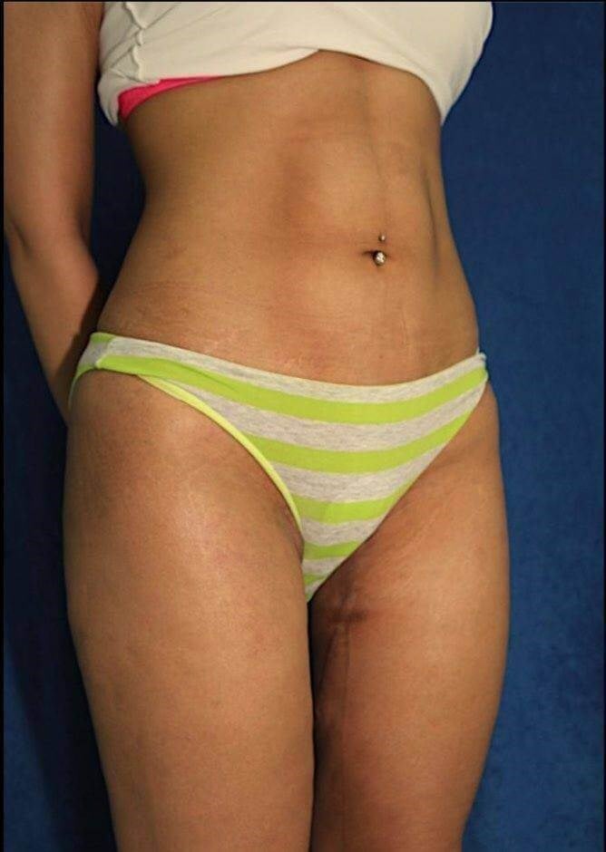 Abdominal Etching With AbSculpt™ Abdominal Etching Hi-Def Laser Liposuction