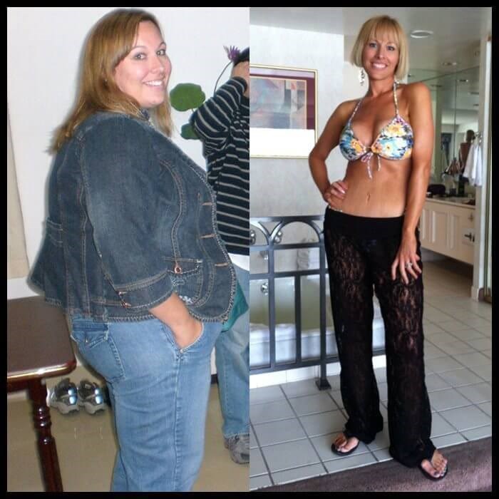 gastric bypass before and after skin